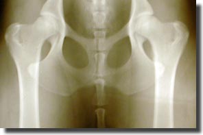Miss Sophies hips x-ray